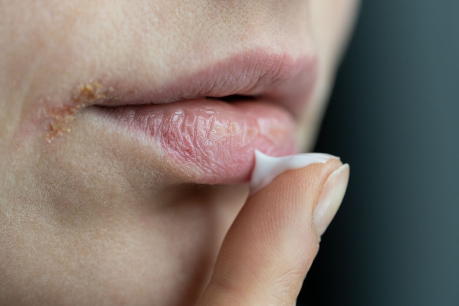 10 Lip Balm Terbaik untuk Mengatasi Bibir Pecah-Pecah