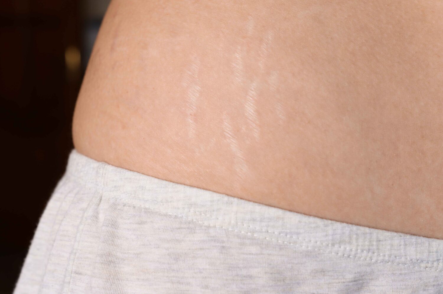 10 Cara Alami Menghilangkan Stretch Mark yang Terbukti Ampuh