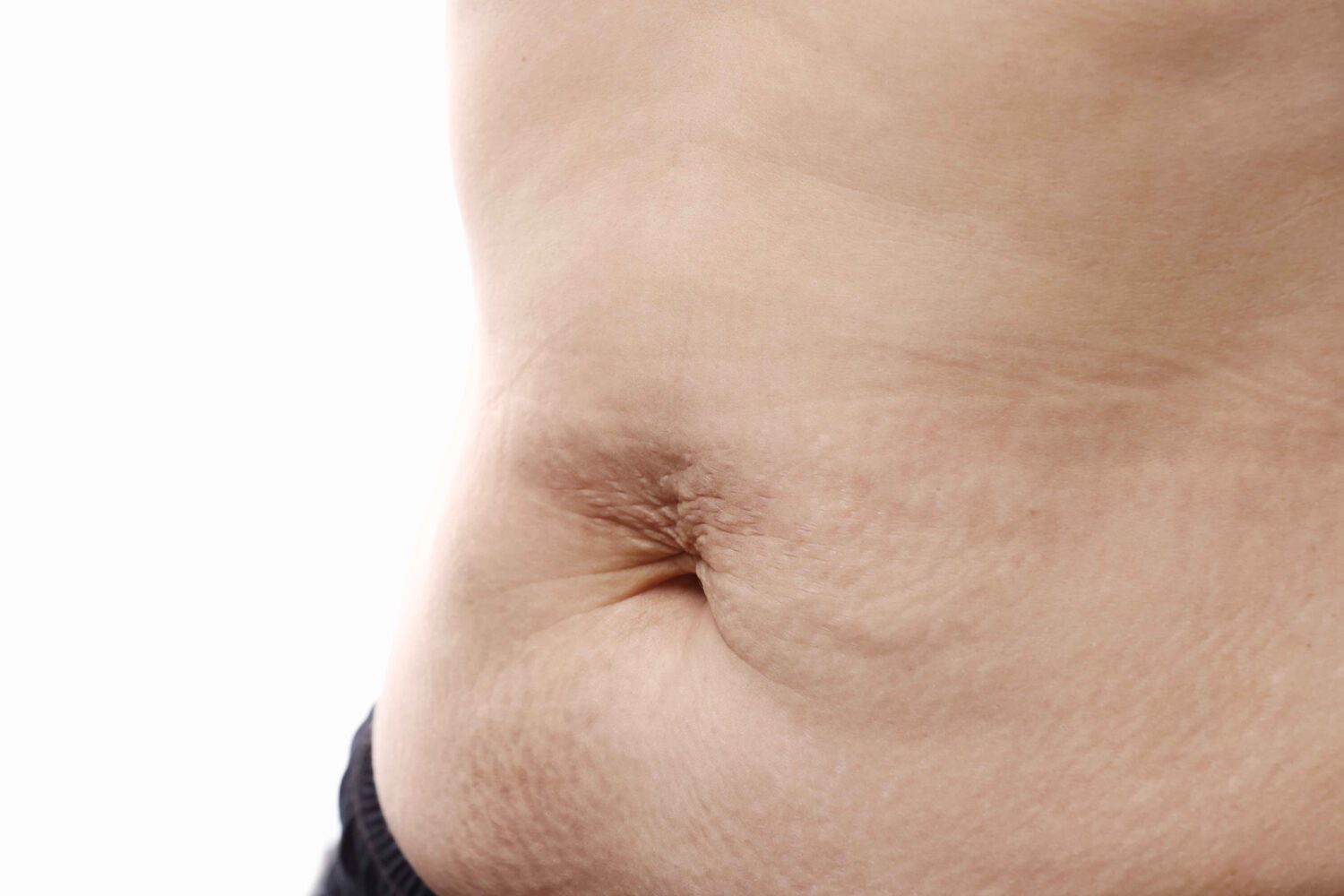 7 Bahan Alami Penghilang Stretch Mark yang Ampuh, Wajib Coba!