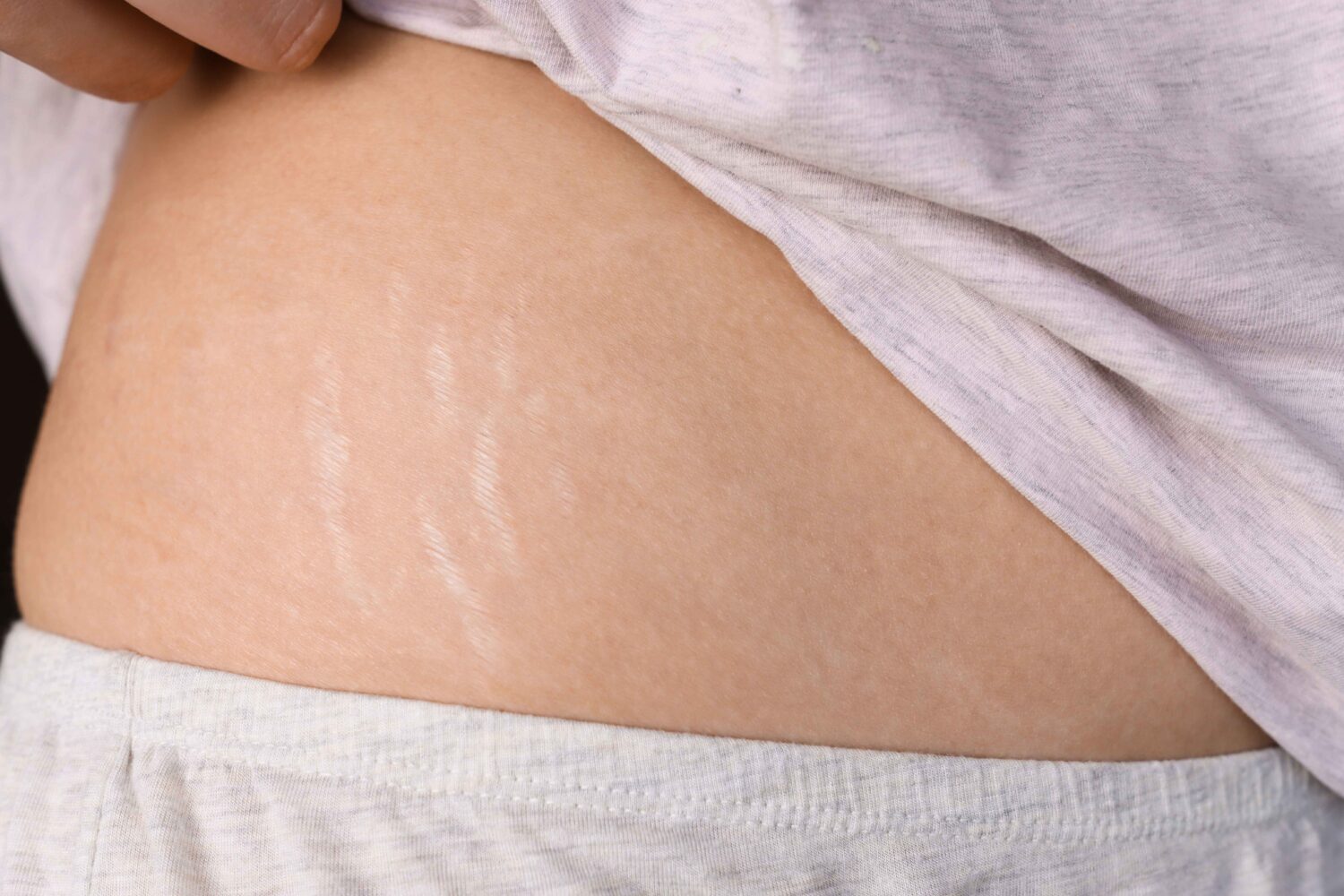 7 Makanan Super yang Bantu Kulitmu Bebas dari Stretch Mark