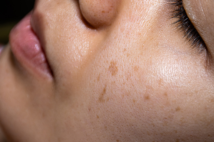 8 Jenis Flek Hitam dan Cara Bedainnya di Kulit Kamu