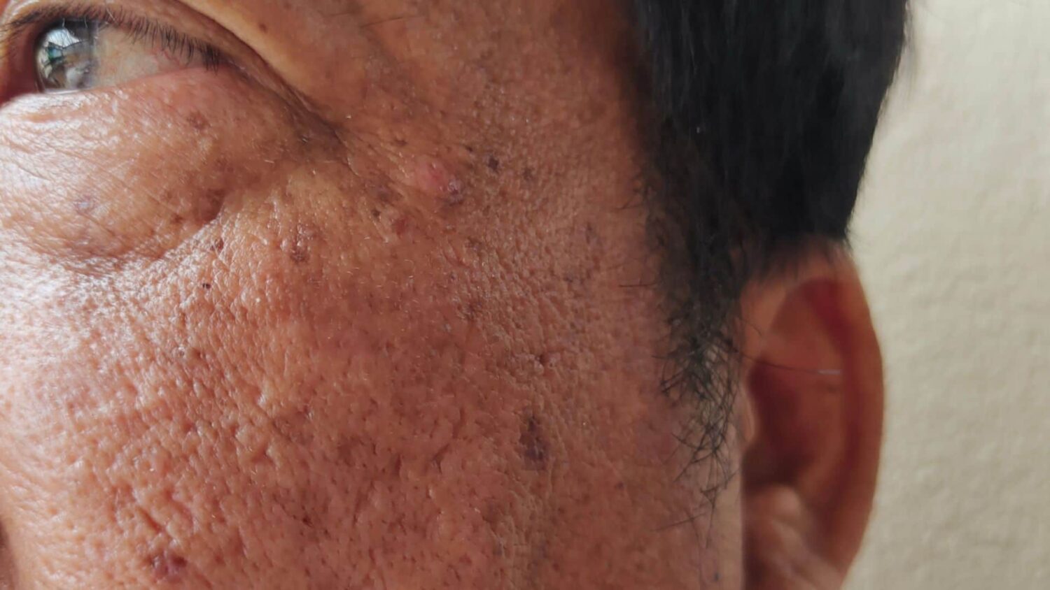 9 Bahan Dapur yang Ampuh Bantu Samarin Flek Hitam