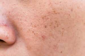 10 Penyebab Flek Hitam di Wajah yang Sering Kamu Nggak Sadar