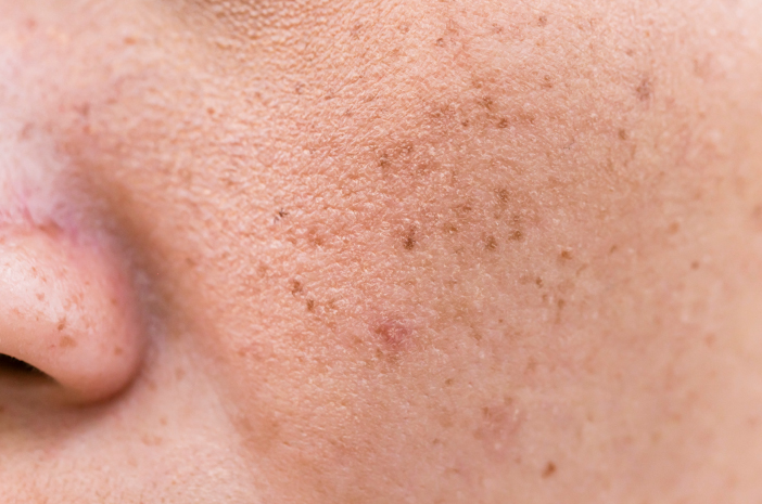 10 Penyebab Flek Hitam di Wajah yang Sering Kamu Nggak Sadar