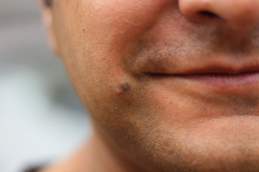 5 Perbedaan Antara Tahi Lalat, Flek Hitam, dan Tanda Lahir